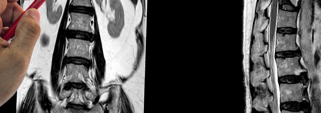 Ressonância da coluna lombar: para que serve e preparo