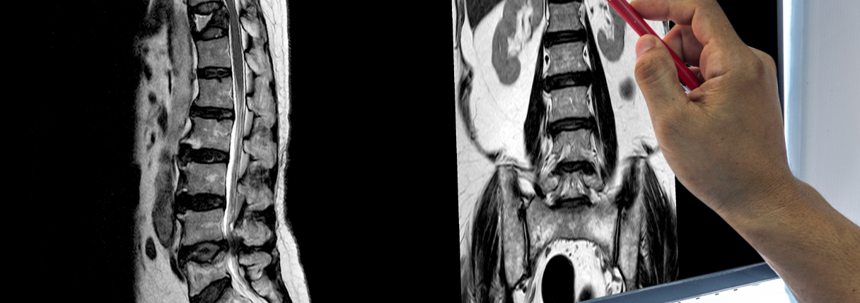 Tomografia da coluna